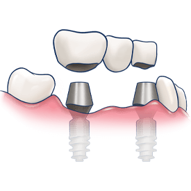 Stomatologiczne uzupełnienia protetyczne oraz aparaty ortodontyczne